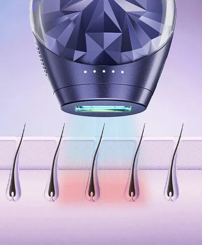 What is the Technology Behind IPL Hair Removal?